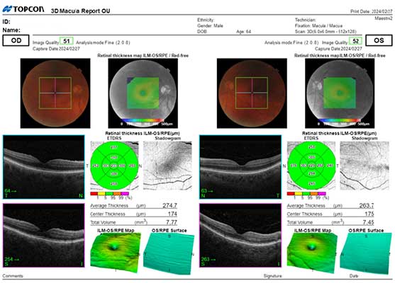 EYE EXAM